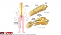 مولتيپل اسکلروز MS