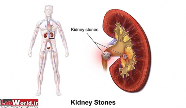 سنگ کلیه و مجاری ادراری 