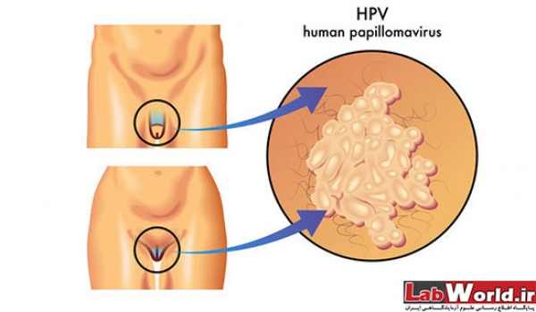 واکسیناسیون علیه ویروس پاپیلومای انسانی