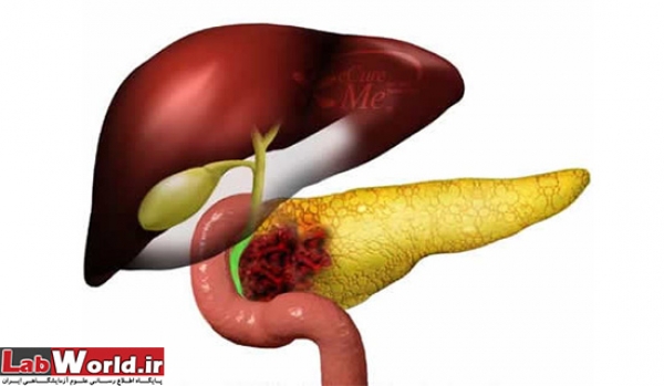 ابداع شیوه جدید،برای درمان سرطان لوزالمعده