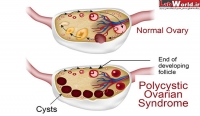 سندرم تخمدان پلی‏کیستیک Polycystic Ovarian Syndrome‏